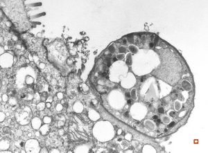 M,33y. | microsporidiosis (or cryptosporidiosis) - duodenum-posttransplantation immunodeficiency M,33y. | microsporidiosis (or cryptosporidiosis) - duodenum-posttransplantation immunodeficiency